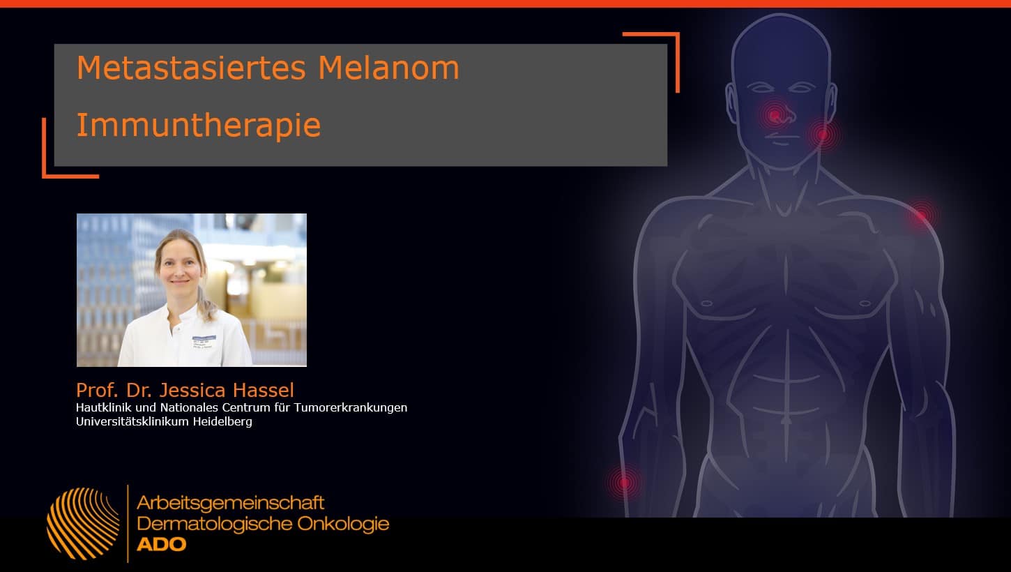 Metastasiertes Melanom – Immuntherapie